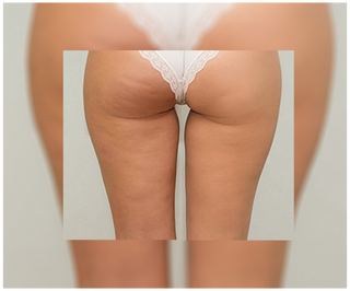 Tabletten gegen Cellulite und für Verbesserung der Kondition der Haut mit natürlichen Extrakten Cellinea 60 Kapseln