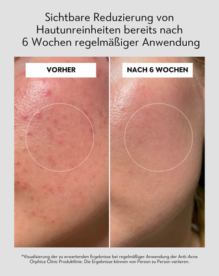 Nachtserum zur Unterstützung der Regeneration von zu Akne neigender Haut Anti-Acne Orphica Clinic 50 ml - 5