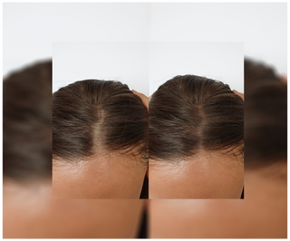 Kapseln gegen Haarausfall mit verdichtender und stärkender Wirkung Follixin 60 Kapseln