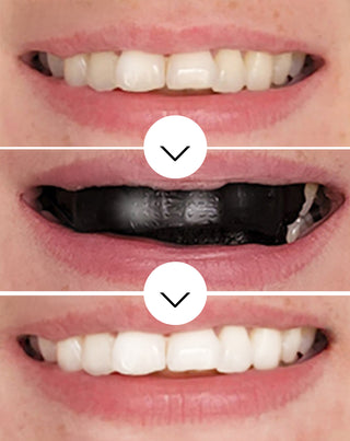 The White(ning) Stripes Smilebite Set 28 Stk.
