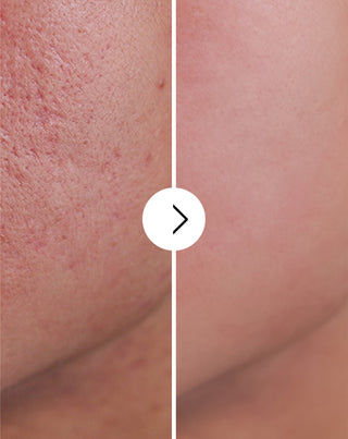 Tabletten gegen Akne, Pickel und Hautunreinheiten mit Zink, Vitamin C, E und B2 Derminax_4