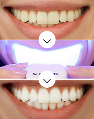 Aufhellungs-Kit mit LED-Lampe und Light & Bright Smilebite Bleaching-Gel - 3